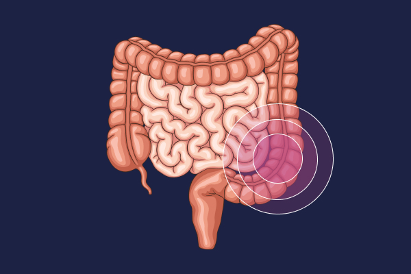 What is ulcerative colitis?
